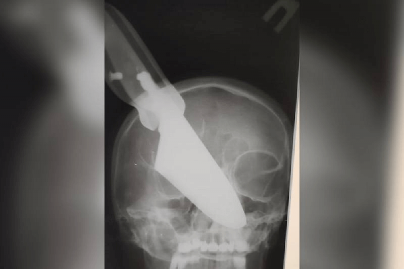 Врачи достали из головы жительницы Кубани 25-сантиметровый нож
