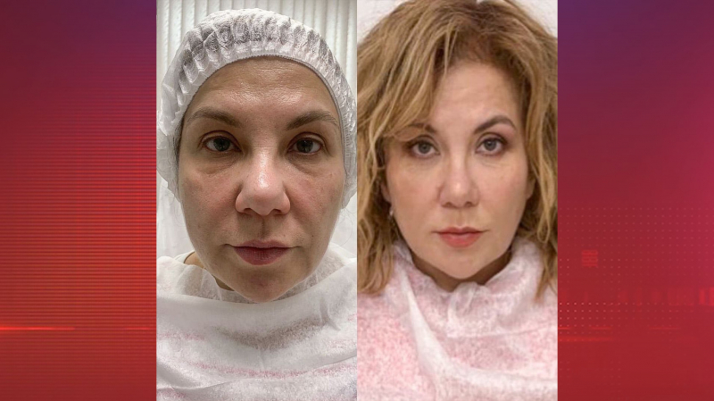 Марина Федункив изменила нос и овал лица без пластической операции — фото